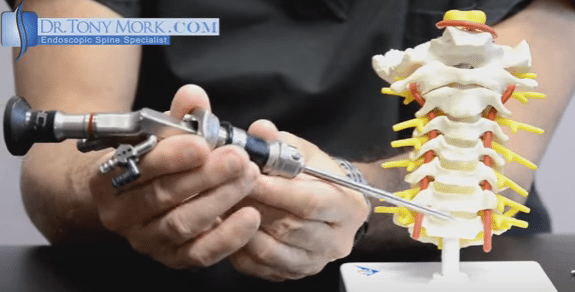 What does Minimally Invasive Spine Surgery (MISS) Mean?