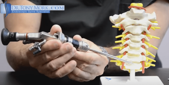 why-choose-minimally-invasive-spine-surgery-hooman-melamed-md