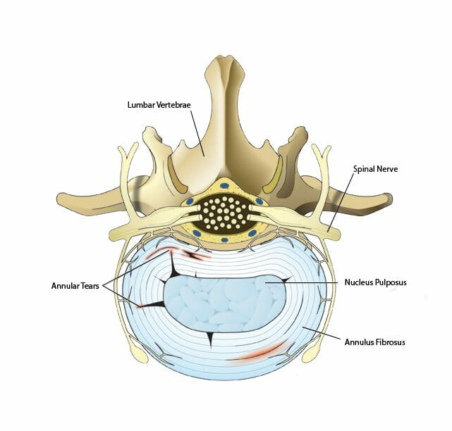 Annular Tears Everything You Need To Know