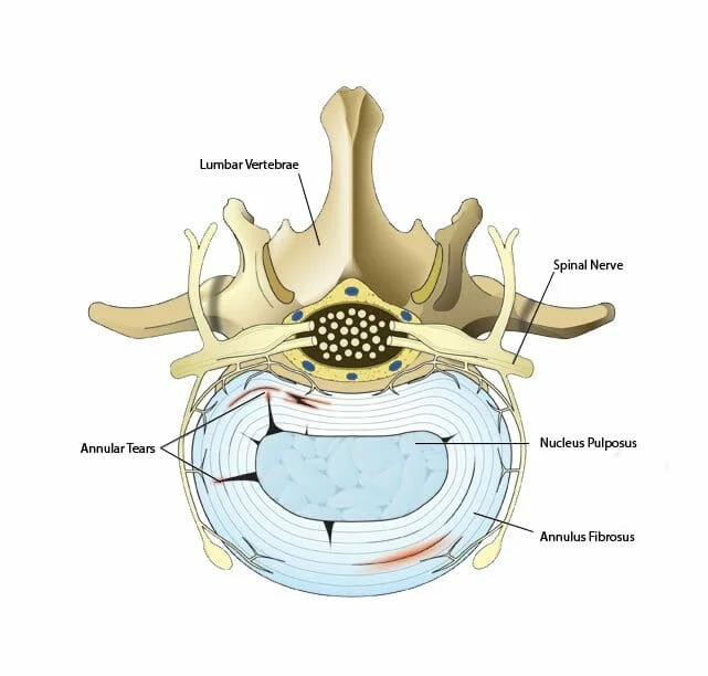 Toxic Annular Tears of the Lumbar Spine