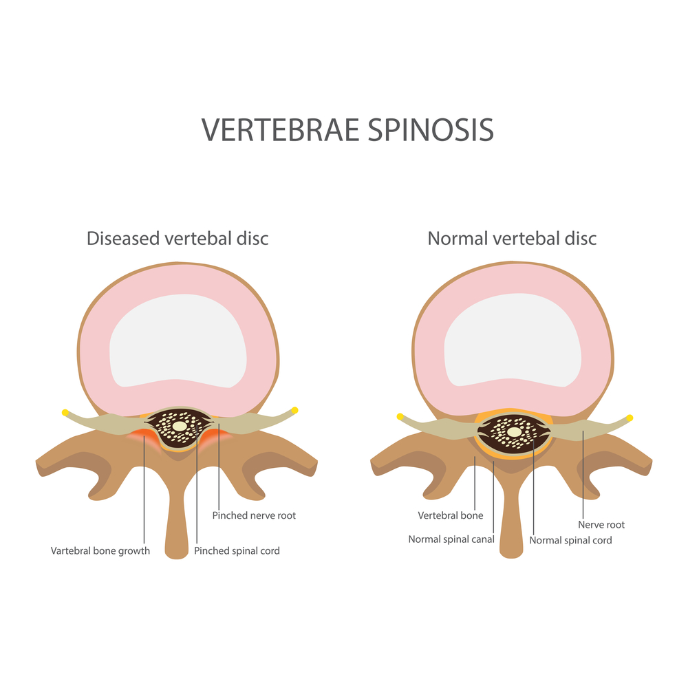 Foraminal Stenosis Treatment Minimally Invasive Spine Surgery