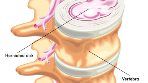 Herniated disc treatment