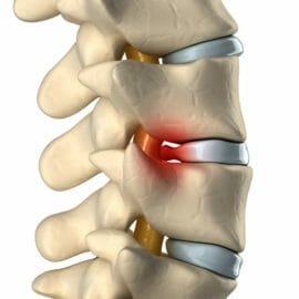 A Patient's Guide to Herniated Discs