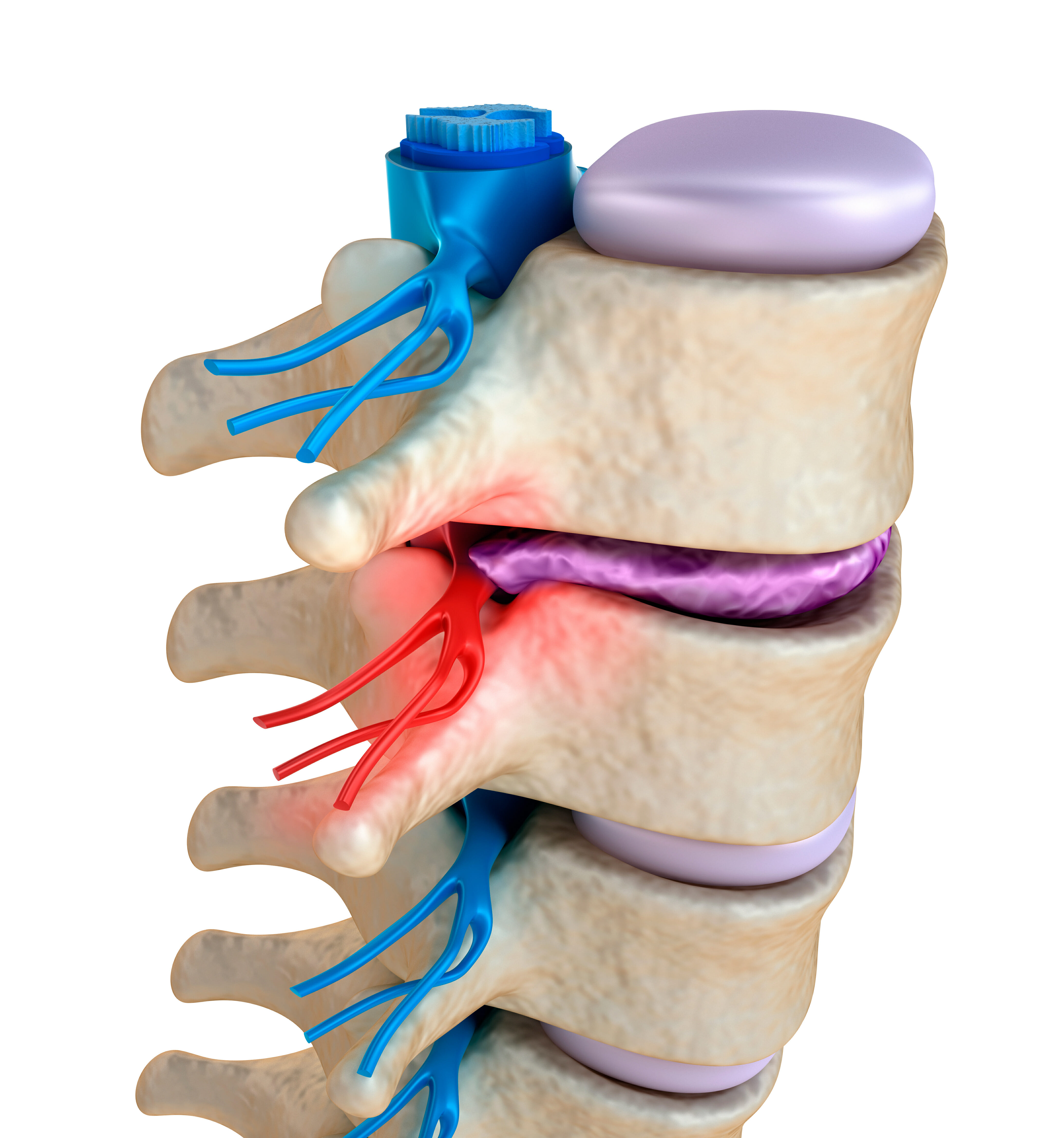 pinched nerve | dr. tony mork