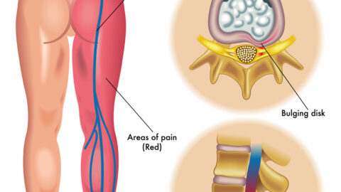 Sciatica treatment