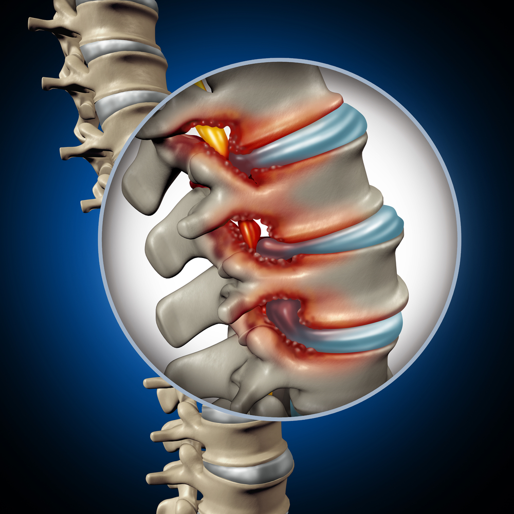 https://drtonymork.com/wp-content/uploads/Spinal-Stenosis-Treatment.jpg