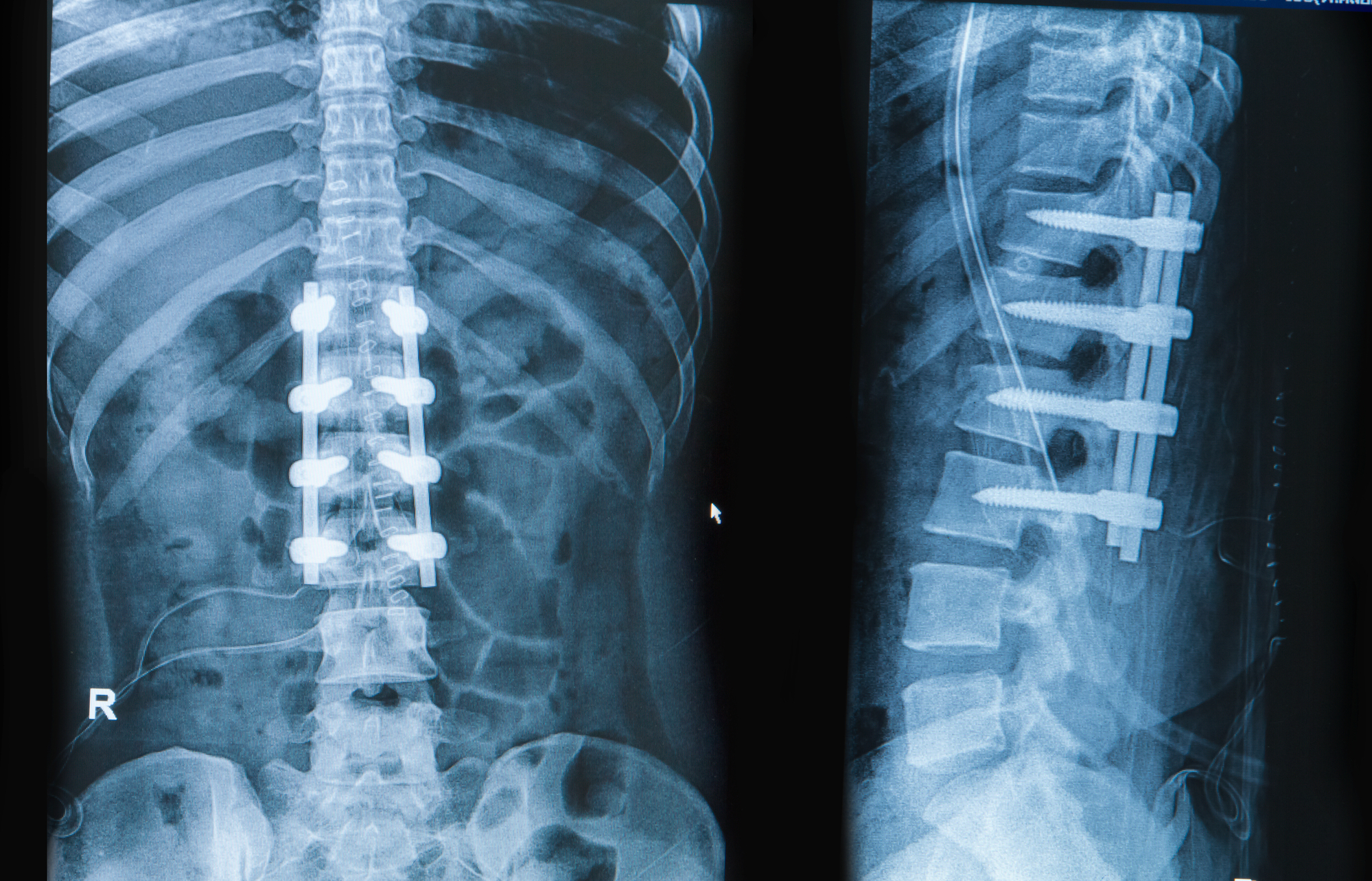 X-ray of inserted hardware after Spinal Fusion Surgery