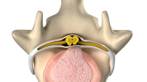 Annular tear treatment