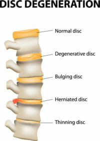 Disc degeneration image