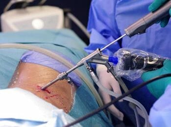Endoscopic spine surgery with endoscope