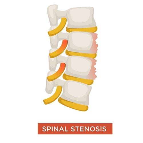 spinal stenosis illustration