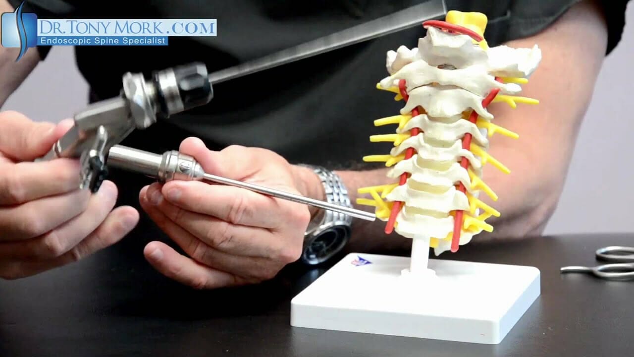 Moderate Cervical Stenosis Symptoms